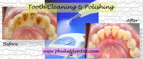 tooth cleaning:Phuket Thailand